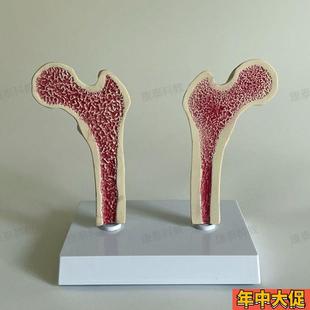 康泰医学模型股骨密度p变化骨质疏松比较长骨干解剖健康病变腿骨