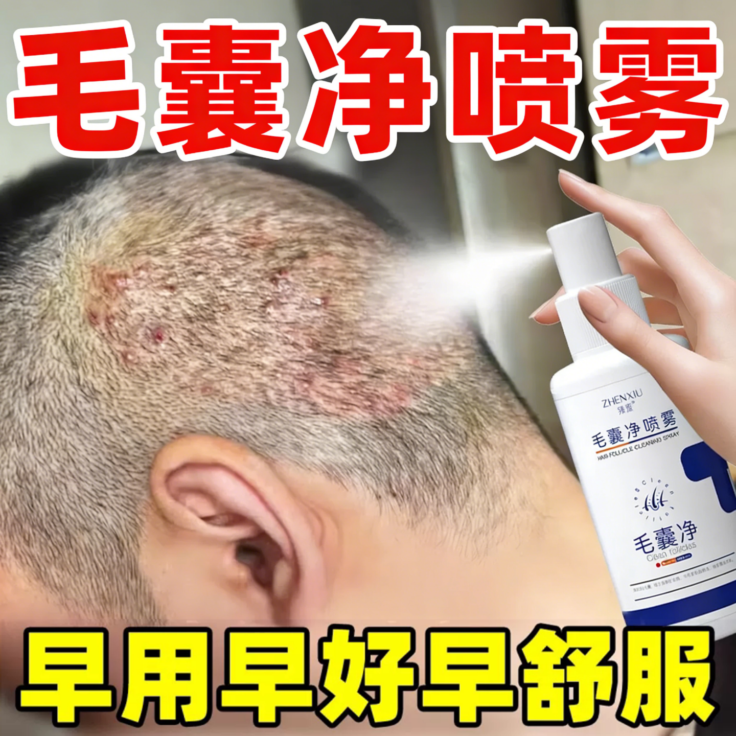 毛囊净喷雾剂毛囊护发头炎皮深层清洁头发干枯毛躁营养护理精华液