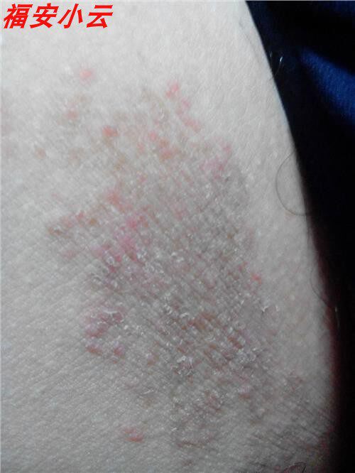 下体痒牛皮癣痒3 百夫灵草本皮肤凝胶百夫灵药膏西安健驰百肤灵软