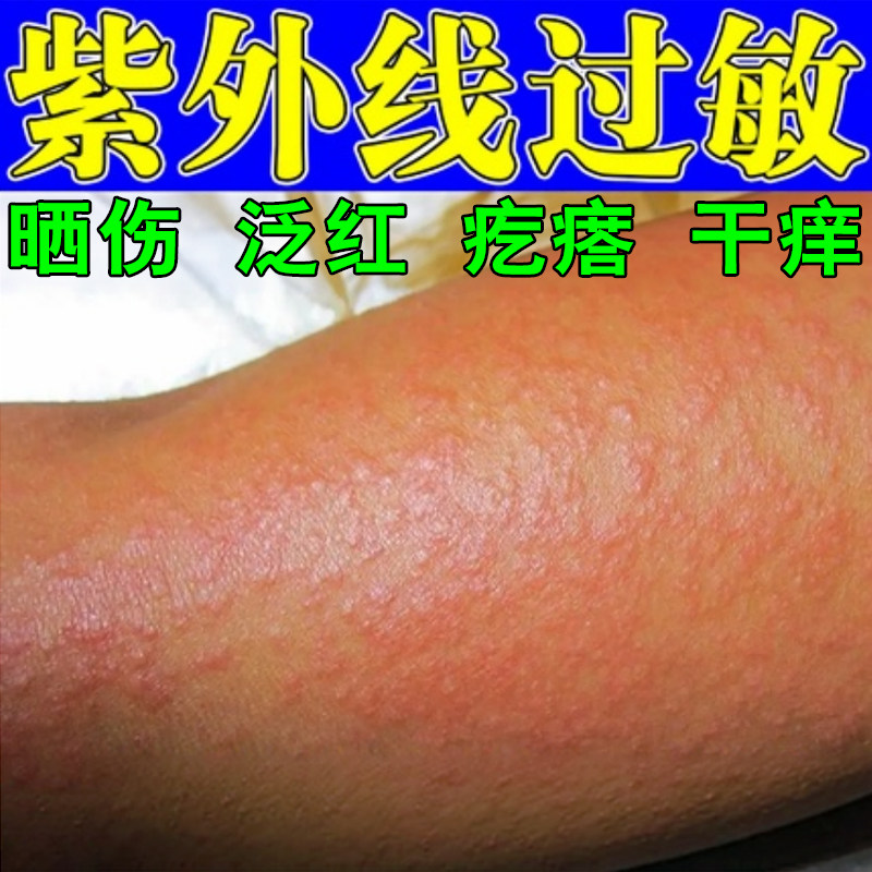 紫外线过敏膏日光性皮肤痒太阳晒伤脖子后背泛红疙瘩干痒晒后痒药