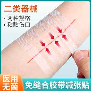 减张贴医用剖腹产皮肤伤口手术儿童减张器小伤口免缝胶带