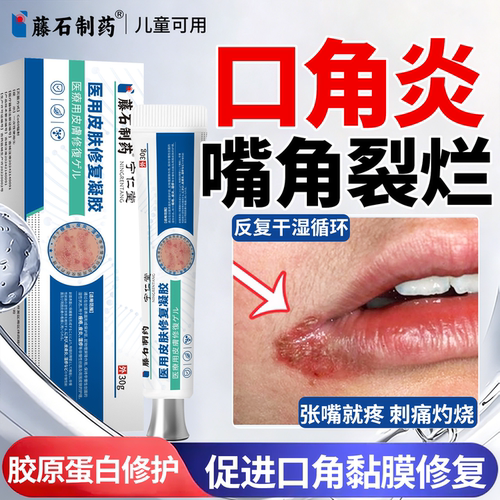 嘴角烂口角炎开裂可搭药膏贴唇炎唇膏嘴角干裂脱皮疱疹儿童正品ON