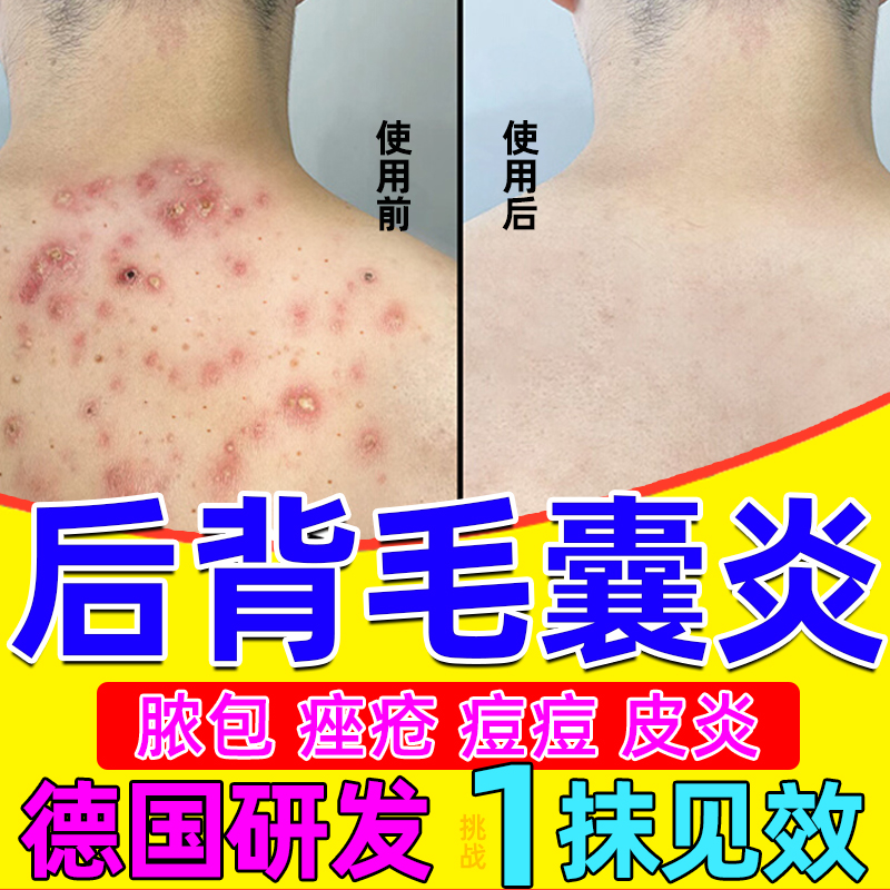 背上长痘痘后背毛囊炎特效马拉色菌药专治毛囊炎用疗膏去鸡皮肤W