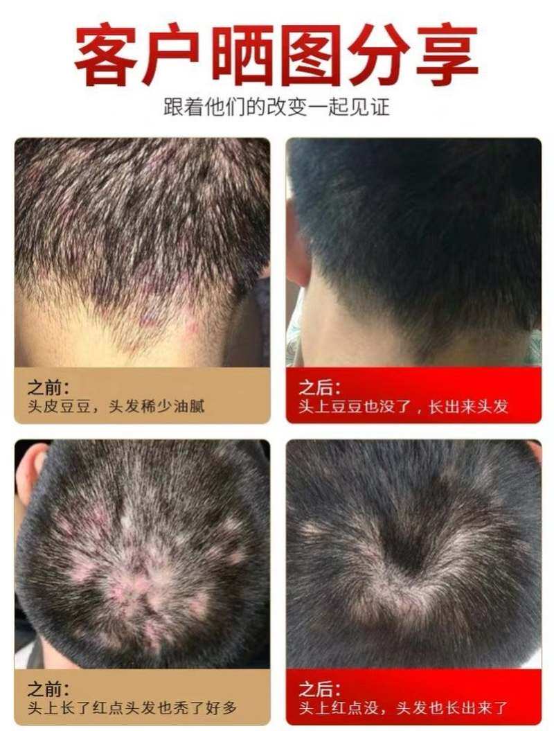 头皮头皮头部头皮癬癬用药头头藓膏荨麻疹藓薬外断根头屑银屑