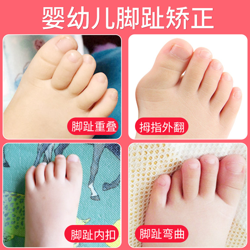 婴儿脚趾矫正器儿童专用宝宝重叠分趾器纠正神器拇指外翻小孩幼儿