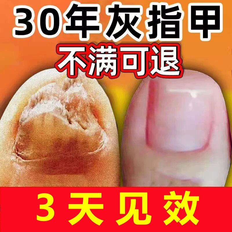 【现货当天发货】灰指甲液脱甲膏