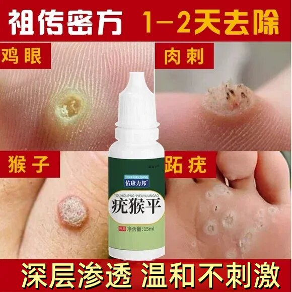 刺猴去除正品去小肉粒灵药祛尤瘊抹无忧子肉刺膏猴子疙瘩正品