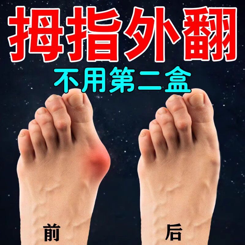拇指外翻贴重症女士大脚骨外翻脚趾重叠防磨拇指外翻膏贴矫正神器