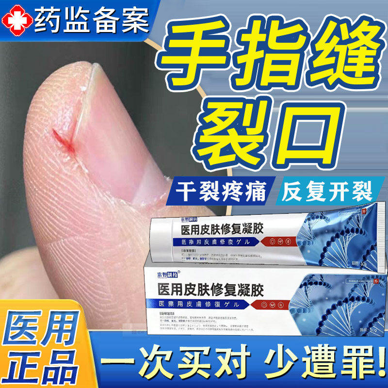 指甲边缘裂口手指头裂口子脱皮开裂干裂真菌感染愈合膏防皲裂TK