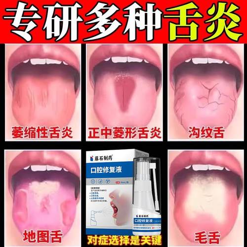 舌炎头康灵喷雾上火裂纹溃