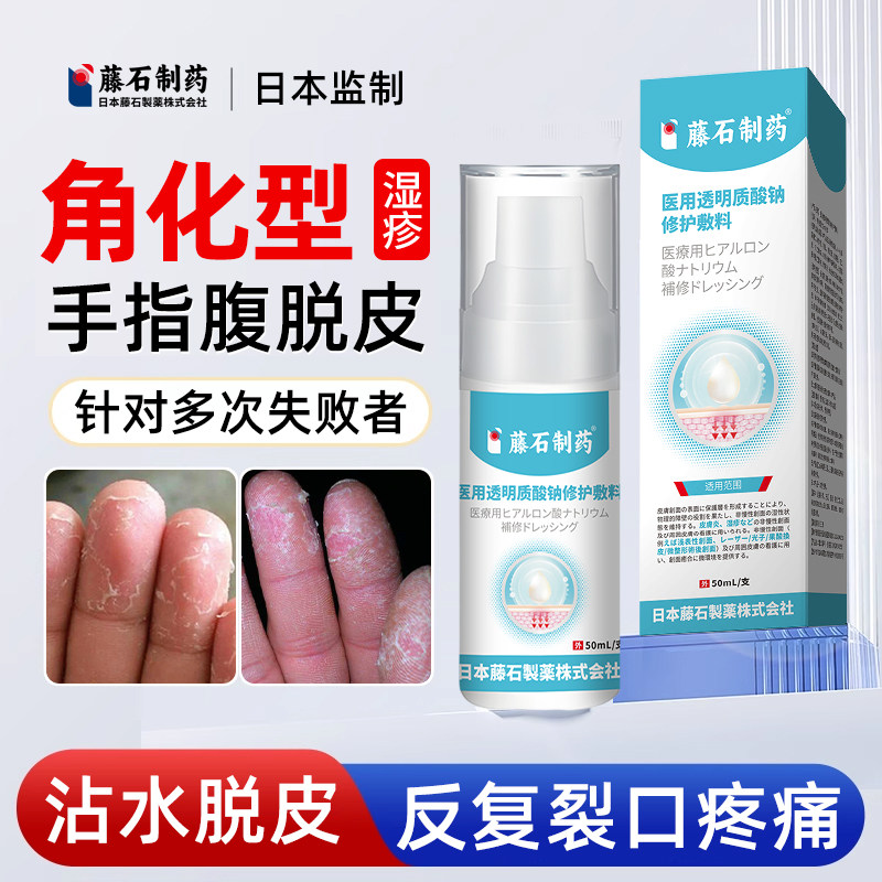 手指角化型湿疹搭手癣膏脱皮干裂真菌感染慢性角质化皲裂性手部TF