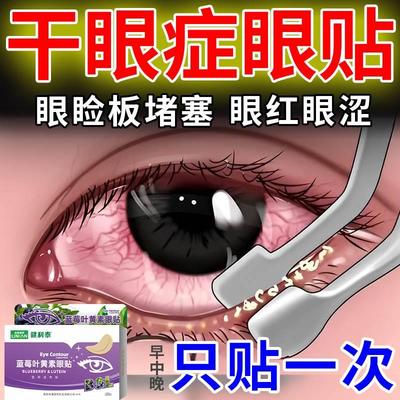 干眼症热敷治疗蒸汽眼罩医用缓解眼疲劳雾化仪治疗干眼症的药DK