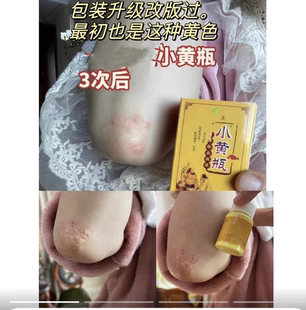 小黄霜一抹灵小黄膏正品小黄瓶皮肤抑jun正品小黄瓶乳膏止yang