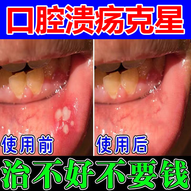 口腔溃疡专用药治疗口疮口腔上火嘴巴起泡烂舌头抑菌口腔溃疡喷剂