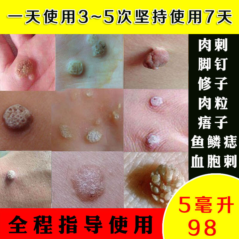 血胞刺去膏治贴休子药祛肉疙瘩手足部痦子专用痦子
