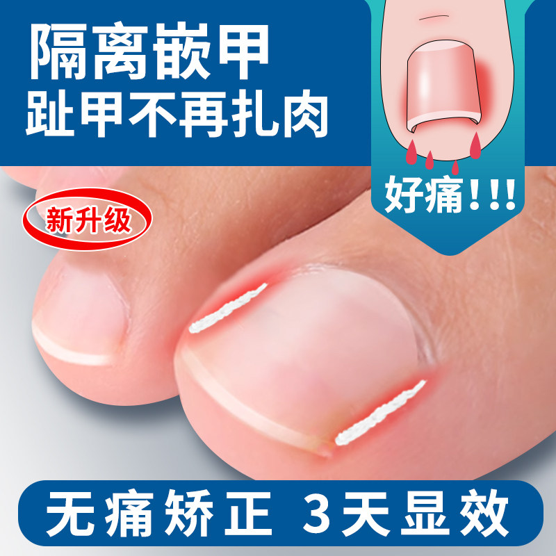甲沟矫正器嵌甲卷甲纠正工具