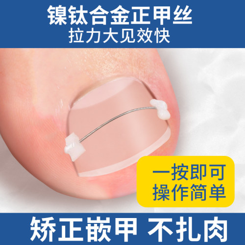 正甲丝甲沟矫正器脚趾甲往肉里长