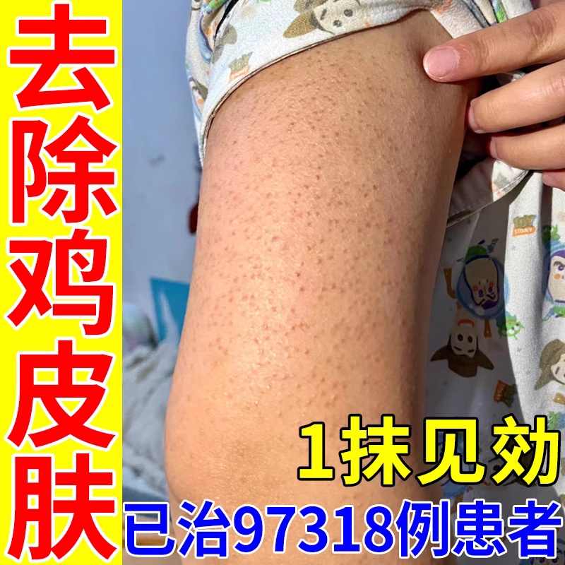 去鸡皮肤疙瘩毛囊角质药膏鱼鳞病皮肤霜毛周角化症鸡皮肤去除神器