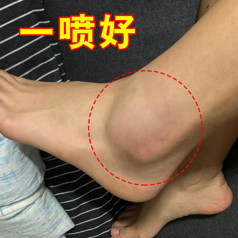 脚腕疼痛专用药脚踝关节酸痛积液肿胀崴脚扭伤脚脖子走路疼活络膏