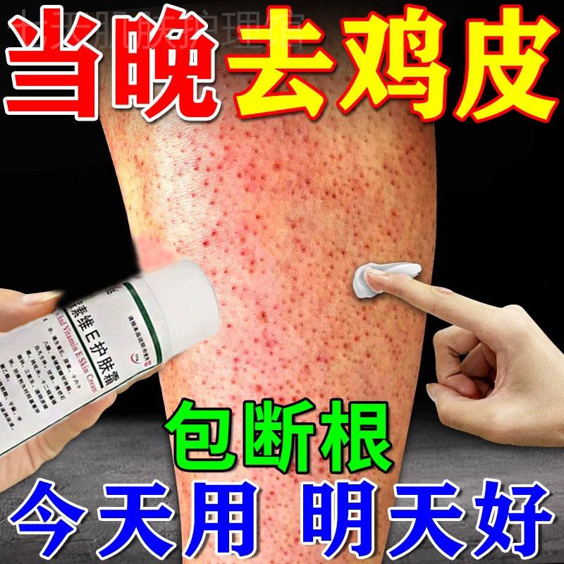 鸡皮肤疙瘩毛囊角化药膏去除儿童全身手臂腿鸡皮肤毛周角化症神器