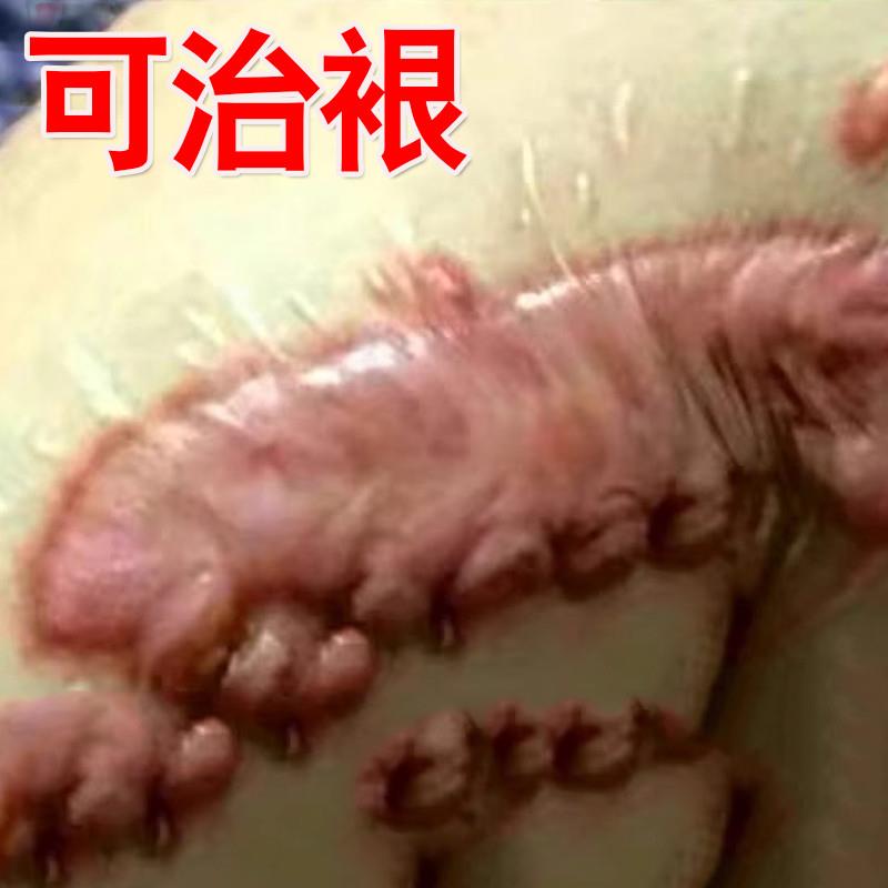 疤痕增生凸起去除疙瘩祛疤软化修复黑色素沉淀烫伤剖腹产特效药膏
