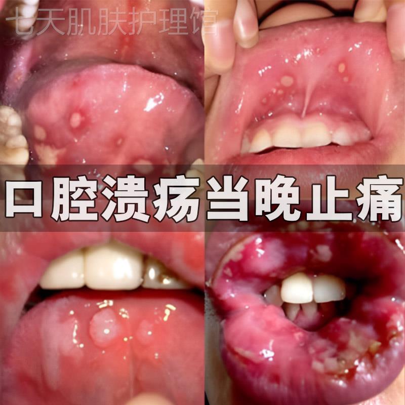 【口腔溃疡】口腔溃烂专用喷剂嘴巴上火疼痛异味克星舌头溃疡喷剂