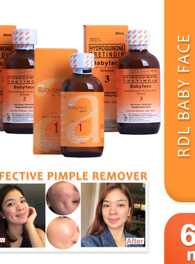 RDL Babyface 1,2,3 60ml 去痘痘精华液 粉刺去除剂