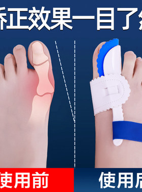大拇脚趾矫正器男女士严