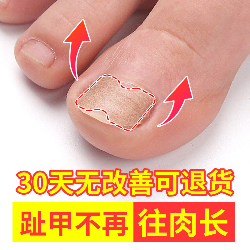 甲沟矫正器正甲贴嵌甲指甲神器长肉里趾甲贴片脚甲纠炎修正修脚沟