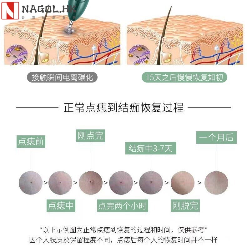 跨境点痣笔美容院家用蓝光脸部点痣扫斑祛斑笔祛痘印黑色素美容仪