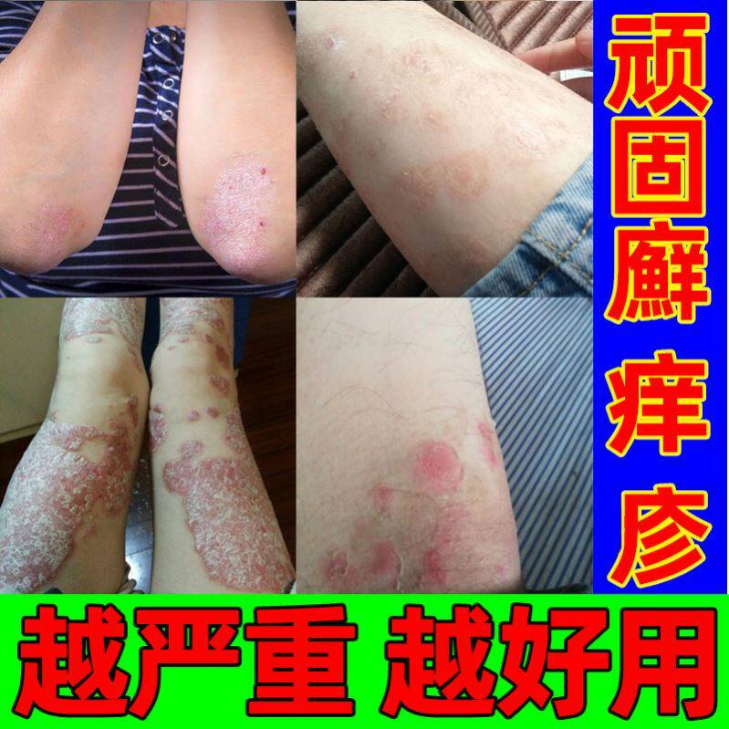 头上有疙瘩手开裂药膏硫磺药膏头部手脱皮真菌感染擦治疗干疮的药