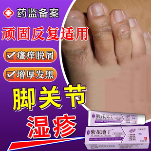脚趾头关节癣脚部湿疹脚癣脚气硬皮角化型真菌感染黑干燥脱皮痒TT