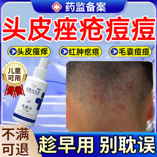 头皮毛囊炎溢脂性皮炎硬疙瘩真菌感染喷雾剂马拉色菌头癣头部MR