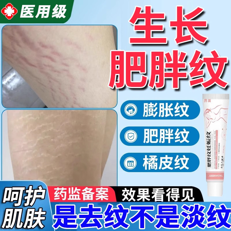 青少年肥胖纹修复霜去肥胖纹修复祛疤产品
