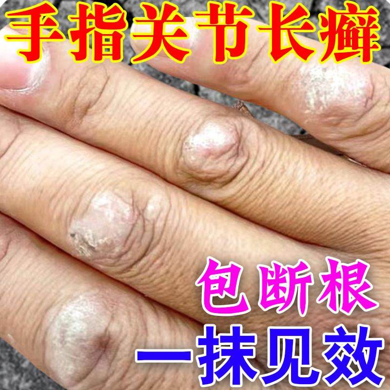 手指关节癣真菌手指关节长硬疙瘩硬块伤癣脱皮干裂手癣手痒专用药
