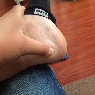 30年专注足跟脚掌跟腱脚底足底专用非药脚后跟发热敷贴膏