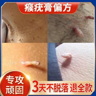 扁平疣瘊子水猴子疙瘩尤瘊小肉粒特面部寻常非除效丝状去疣药膏去