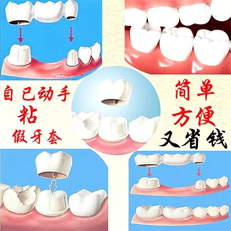 牙科自己动手粘烤瓷牙胶水牙齿钢牙套牙冠假牙专用牙科胶水粘接剂
