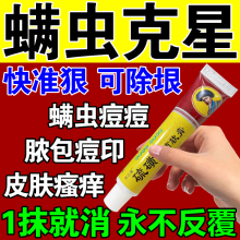 螨虫药膏止痒特效药人用脸上螨虫除螨祛痘后背杀菌淡化痘印专用药