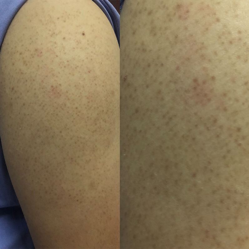 锦州治鸡皮肤(锦州治鸡皮肤专科医院) 锦州治鸡皮肤(锦州治鸡皮肤专科医院)