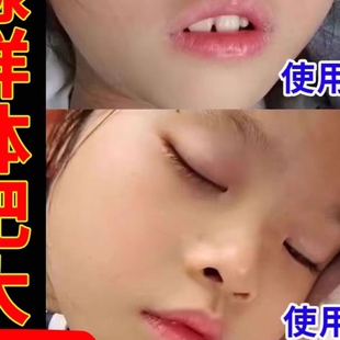 腺状样体中药贴【儿童专用】儿童塞鼻张嘴呼吸噘嘴打呼噜面容调理