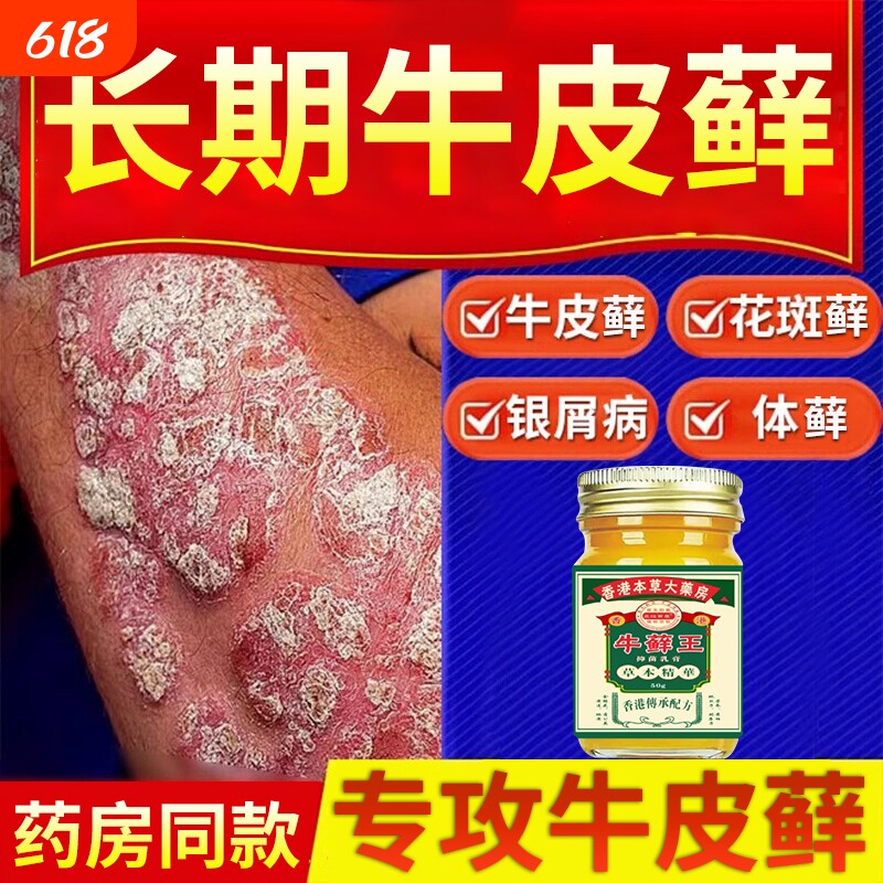 香港牛藓王牛皮痒癣头皮股银去屑病专用膏正品皮肤杀菌止痒抑菌