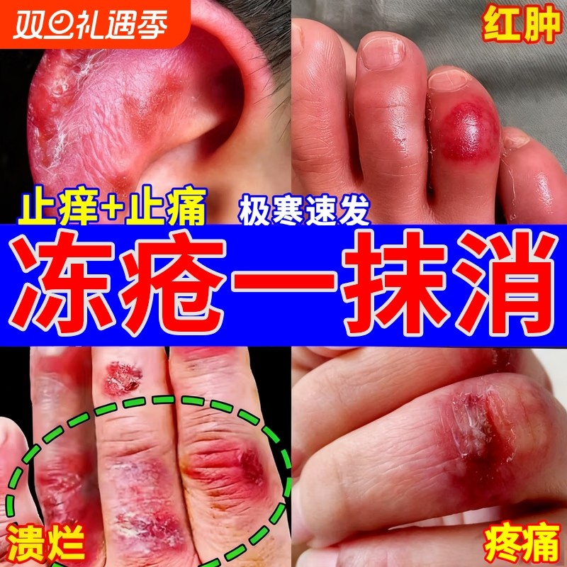 冻疮膏缓解干痒｜10000+人加购