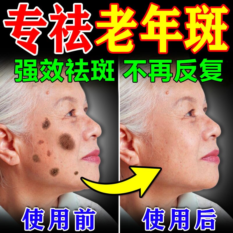 老年斑美白祛斑霜黄褐专用膏药强力去手部除脸部一擦就掉中老年人图片