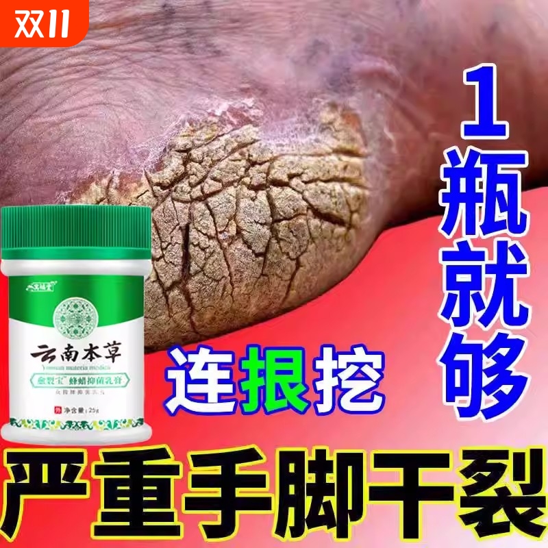 去脚后跟死皮软化剂死皮膏专治脚裂干裂起硬皮足跟开裂修复脚跟