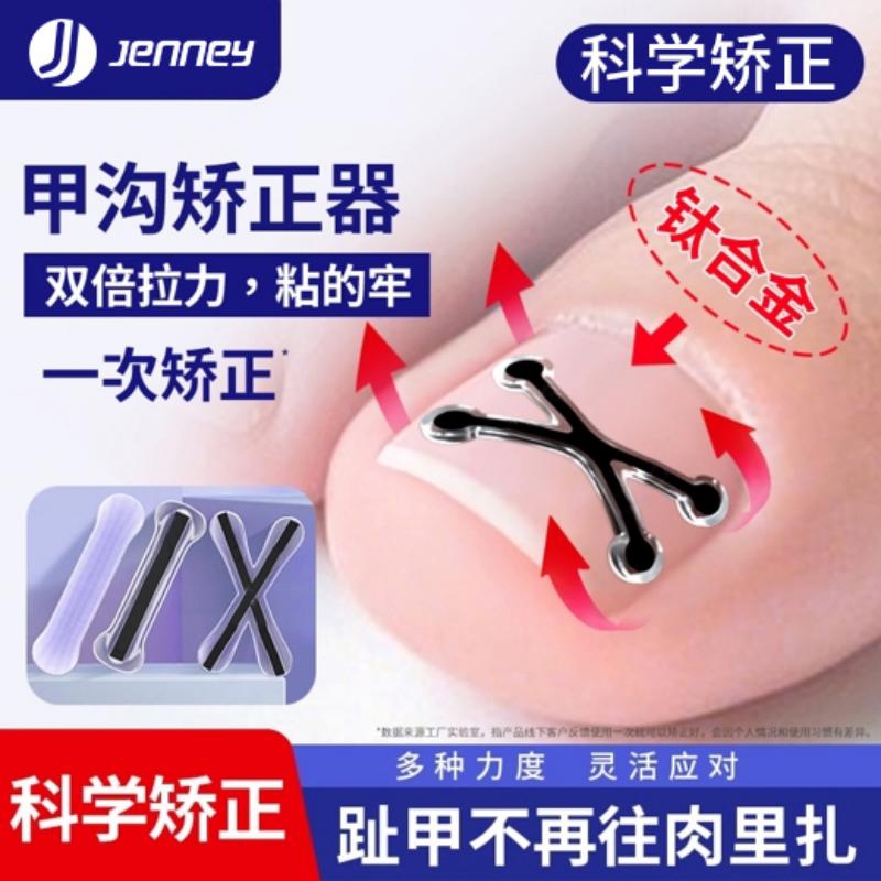 【无感矫正】拉出肉里的趾甲