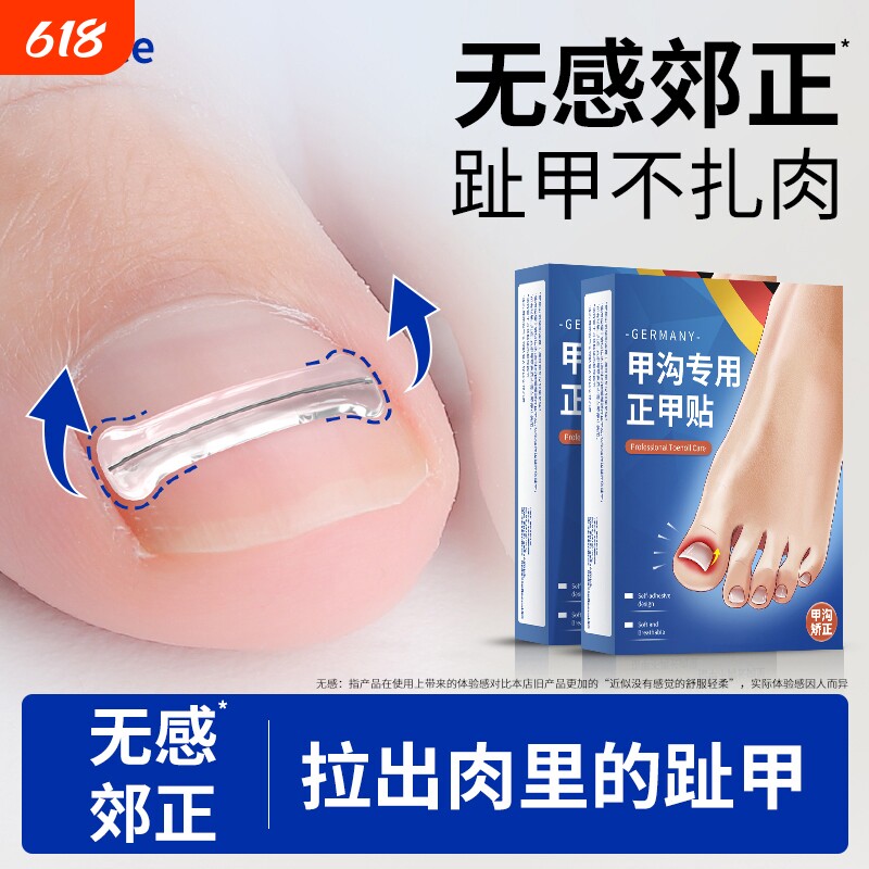 甲沟嵌甲矫正器指甲正甲贴片贴片脚趾专用工具指甲刀趾甲炎钢丝