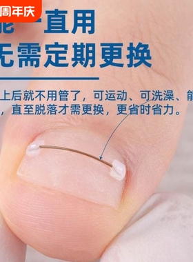 上宾足科甲沟嵌甲矫正器钛合金弹丝纠正甲贴片脚趾甲指甲炎足科