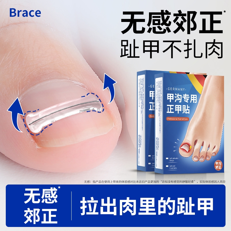 【3天显效】无感矫正嵌甲