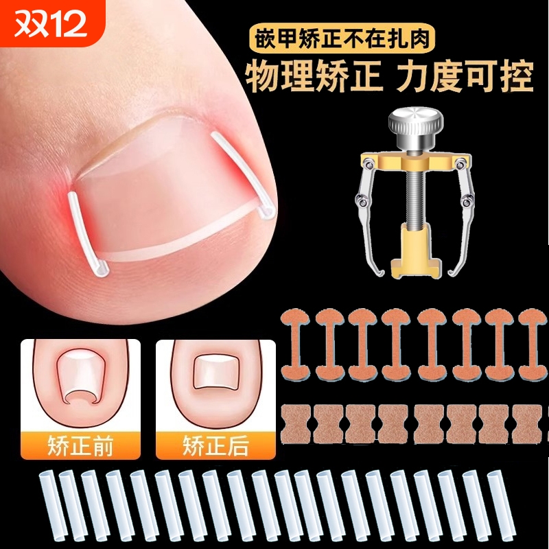 甲沟矫正器嵌甲贴片炎防脚指甲往肉里长专用工具隔离填充垫片神器